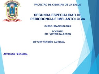 ARTICULO PERSONAL
FACULTAD DE CIENCIAS DE LA SALUD
SEGUNDA ESPECIALIDAD DE
PERIODONCIA E IMPLANTOLOGIA
CURSO: IMAGENOLOGIA
DOCENTE:
DR. VICTOR CALDERON
• CD YURY TENORIO CAHUANA
 