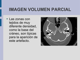 IMAGEN VOLUMEN PARCIAL Las zonas con tejidos de muy diferente densidad, como la base del cráneo, son típicas para la aparición de este artefacto. 