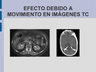 EFECTO DEBIDO A MOVIMIENTO EN IMÁGENES TC 