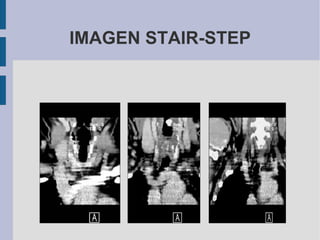 IMAGEN STAIR-STEP 