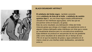 El artefacto del límite negro , también conocido
como artefacto de tinta de la India o artefacto de cambio
químico tipo 2 , es una línea negra creada artificialmente
ubicada en las interfaces agua-grasa, como las que se
encuentran entre el músculo y la grasa.
Esto da como resultado una delineación nítida del límite
músculo-grasa que otorga a la imagen una apariencia como si
alguien hubiera delineado estas interfaces con tinta que a veces
es visualmente atractiva pero no una estructura anatómica.
Este artefacto se produce en secuencias de eco de gradiente
(GE) como resultado de la selección de un tiempo de eco
(TE) en el que los espines de grasa y agua (ubicados en el
mismo vóxel en una interfaz) están desfasados, cancelando
entre sí.
BLACK BOUNDARY ARTIFACT
 