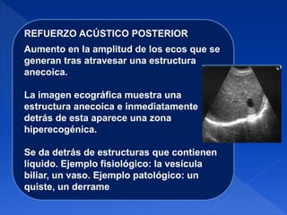 REFUERZO ACÚSTICO POSTERIOR
Aumento en la amplitud de los ecos que se
generan tras atravesar una estructura
anecoica.
La imagen ecográfica muestra una
estructura anecoica e inmediatamente
detrás de esta aparece una zona
hiperecogénica.
Se da detrás de estructuras que contienen
líquido. Ejemplo fisiológico: la vesícula
biliar, un vaso. Ejemplo patológico: un
quiste, un derrame
 