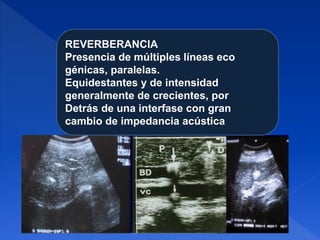 REVERBERANCIA
Presencia de múltiples líneas eco
génicas, paralelas.
Equidestantes y de intensidad
generalmente de crecientes, por
Detrás de una interfase con gran
cambio de impedancia acústica
 