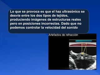 Lo que se provoca es que el haz ultrasónico se
desvíe entre los dos tipos de tejidos,
produciendo imágenes de estructuras reales
pero en posiciones incorrectas. Dado que no
podemos controlar la velocidad del sonido
 