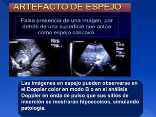 Las imágenes en espejo pueden observarse en
el Doppler color en modo B o en el análisis
Doppler en onda de pulso que sus sitios de
inserción se mostrarán hipoecoicos, simulando
patología.
 