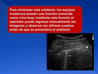 Para minimizar este artefacto, los equipos
modernos poseen una función conocida
como cine-loop; mediante esta función el
operador puede regresar manualmente las
imágenes y observar los últimos cuadros
antes de que se presentara el artefacto
 