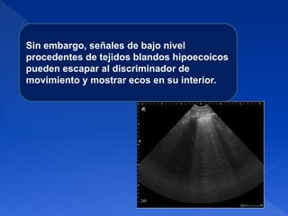 Sin embargo, señales de bajo nivel
procedentes de tejidos blandos hipoecoicos
pueden escapar al discriminador de
movimiento y mostrar ecos en su interior.
 