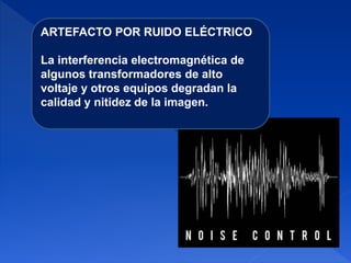 ARTEFACTO POR RUIDO ELÉCTRICO
La interferencia electromagnética de
algunos transformadores de alto
voltaje y otros equipos degradan la
calidad y nitidez de la imagen.
 