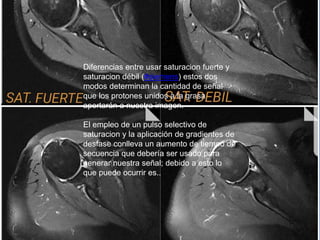 Diferencias entre usar saturacion fuerte y
saturacion débil (#siemens) estos dos
modos determinan la cantidad de señal
que los protones unidos a la grasa
aportarán a nuestra imagen.
El empleo de un pulso selectivo de
saturacion y la aplicación de gradientes de
desfase conlleva un aumento de tiempo de
secuencia que debería ser usado para
generar nuestra señal; debido a esto lo
que puede ocurrir es..
 