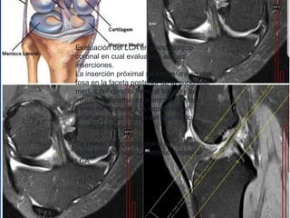 Evaluación del LCA en plano oblicuo
coronal en cual evaluamos ambas
inserciones.
La inserción próximal se encuentra en una
fosa en la faceta posterior de la superficie
medial del condilo femoral lateral y la
insercion distal se encuentra en la fosa
frente de Y lateral a la espina tribial
anterior y pasa debajo del ligamento
meniscal transverso.
Se puede usar como plano único o en
complemento al plano oblicuo sagital al
LCA.
 