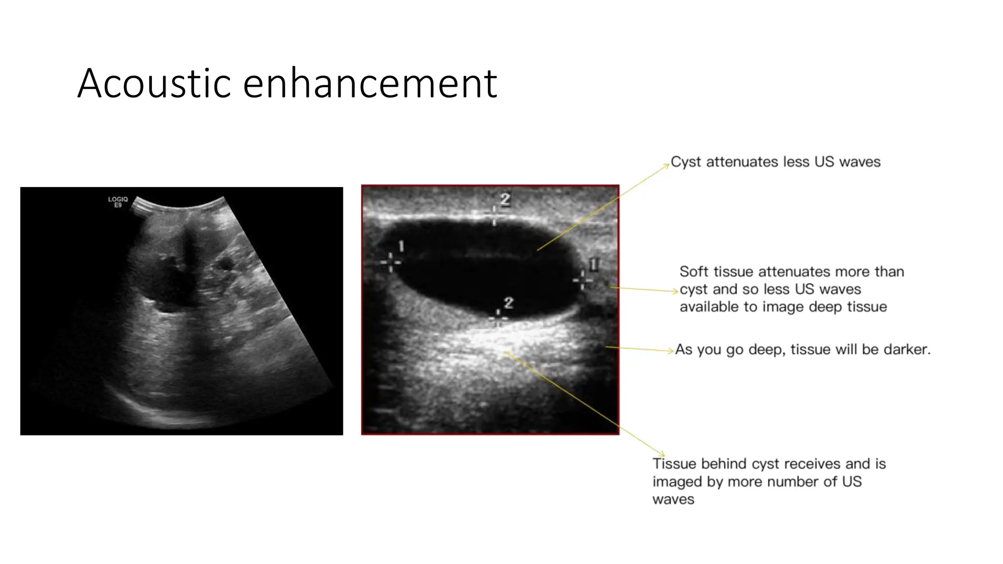 Artefacts In Ultrasound Imaging Physics Pptx