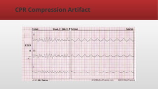 ECG DISCUSSION BASED -Artefacts.ppt.pptx