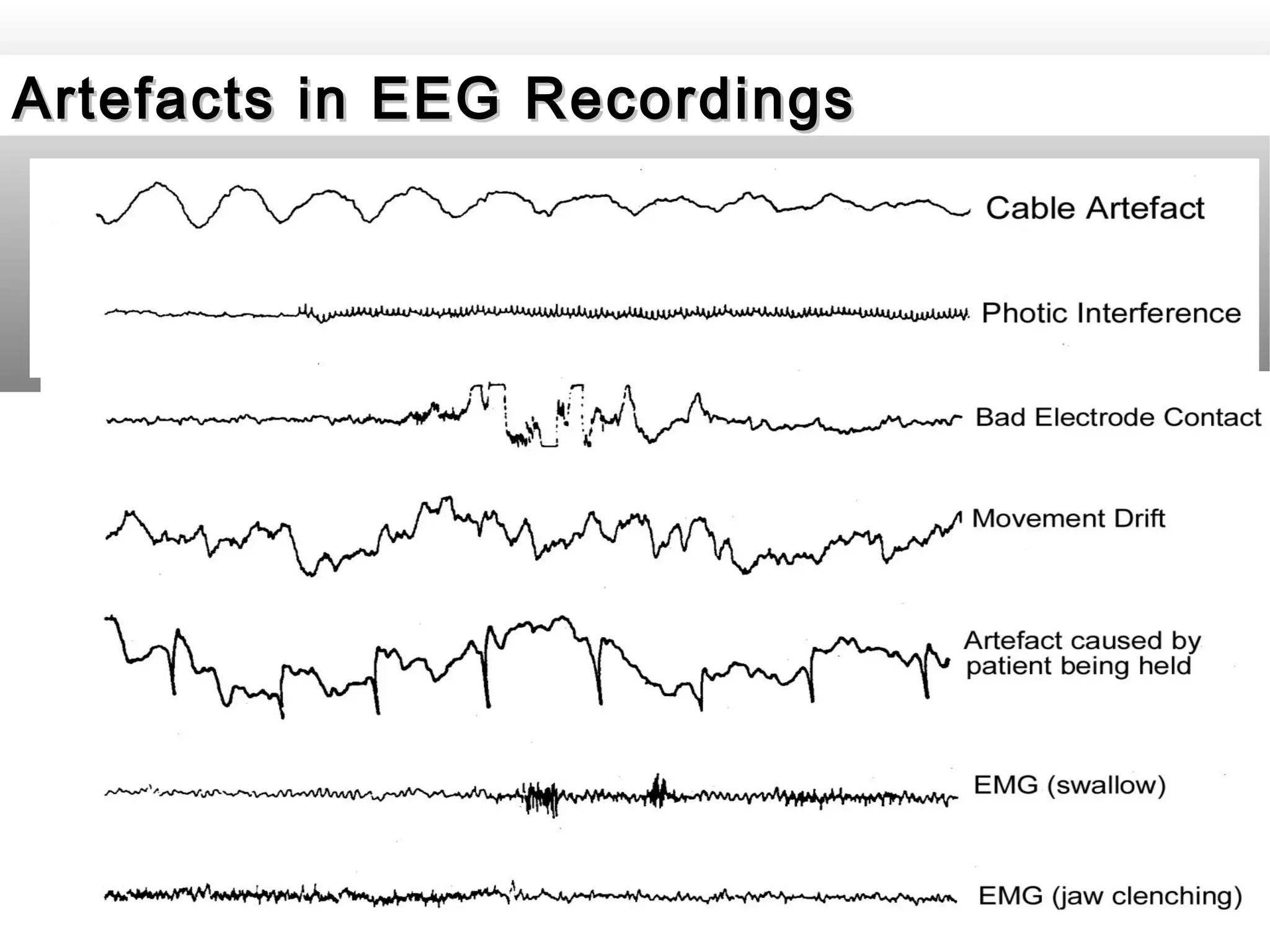 Artifacts in EEG - Recognition and differentiation | PPT