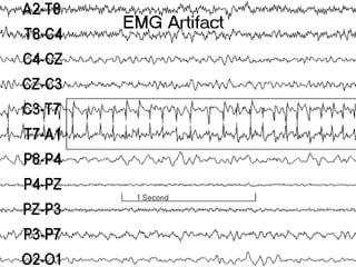 Artifacts in EEG - Recognition and differentiation | PPT
