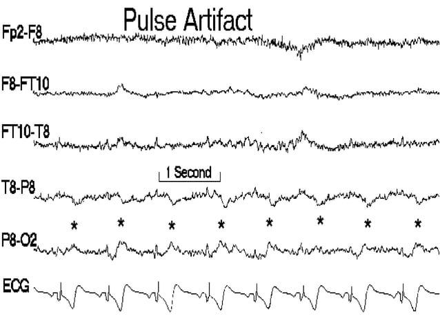 Artifacts in EEG - Recognition and differentiation | PPT