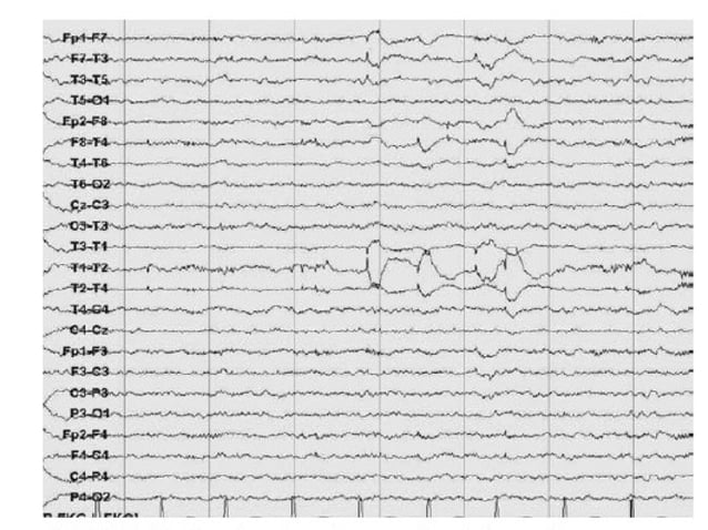 Artifacts in EEG - Recognition and differentiation | PPT