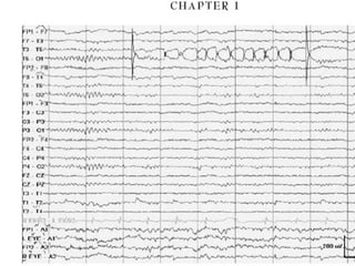 Artifacts in EEG - Recognition and differentiation | PPT