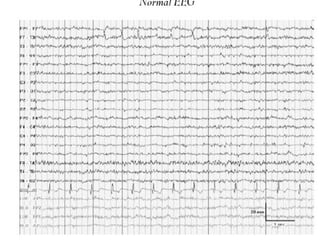 Artifacts in EEG - Recognition and differentiation | PPT