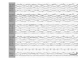 Artifacts in EEG - Recognition and differentiation | PPT