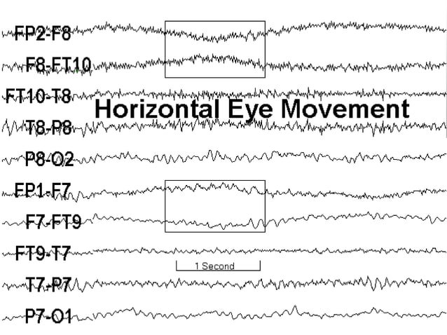 Artifacts in EEG - Recognition and differentiation | PPT