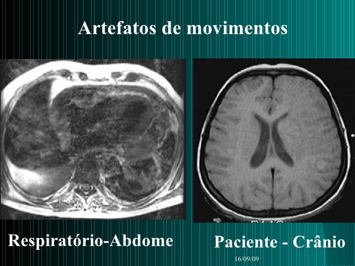 Artefatos Na Imagem Resson ncia Magn tica Artefatos Na Imagem Resson ncia Magn tica