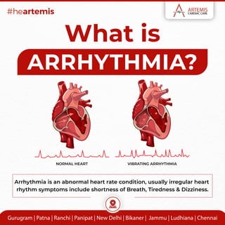 What is
ARRHYTHMIA?
Arrhythmia is an abnormal heart rate condition, usually irregular heart
rhythm symptoms include shortness of Breath, Tiredness & Dizziness.
NORMAL HEART VIBRATING ARRHYTHMIA
 