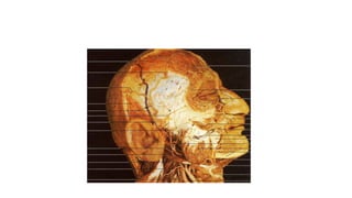 Arteria carótida externa