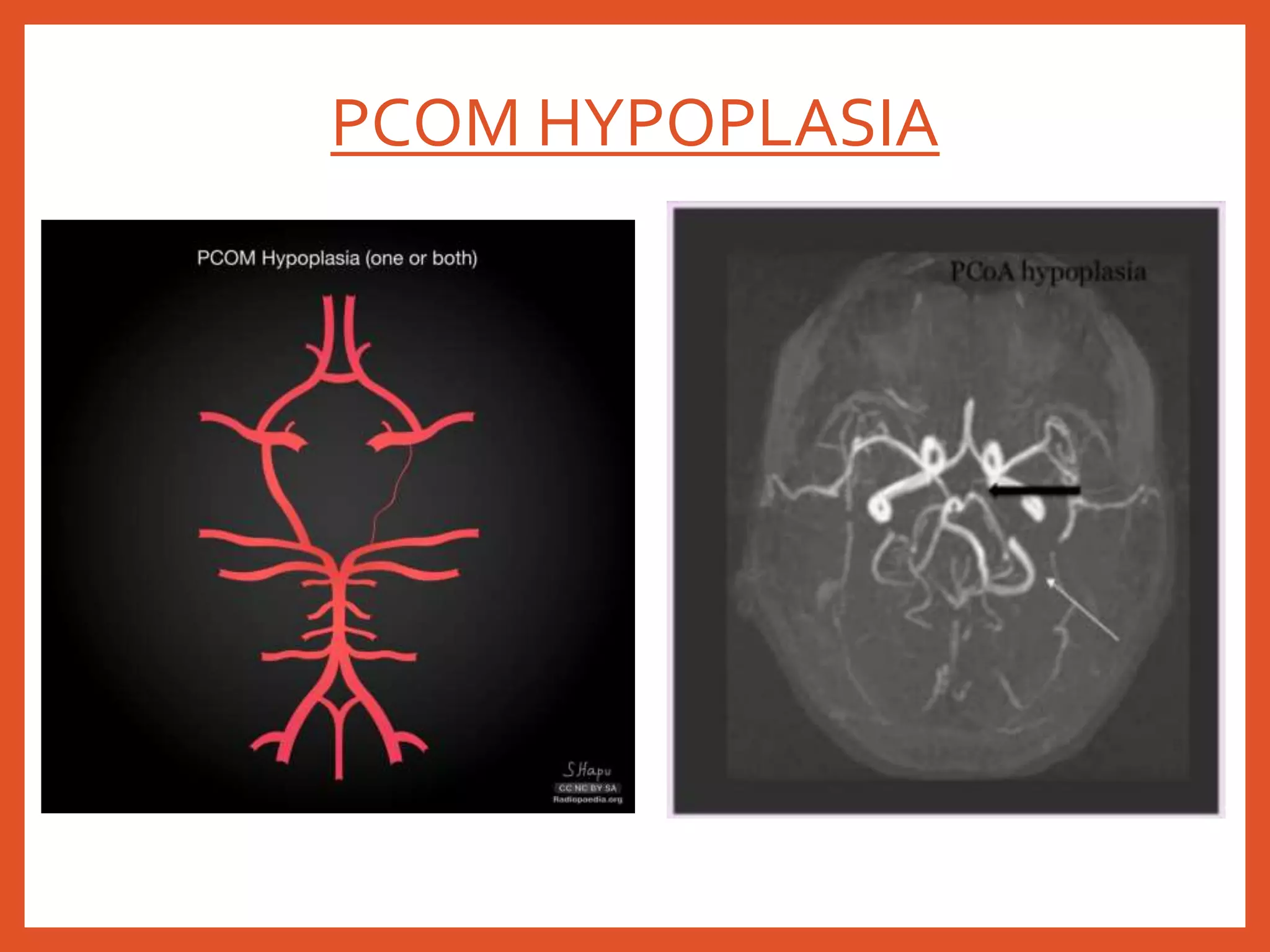 Arterial anatomy of Brain | PPTX