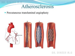 Atherosclerosis
 Percutaneous transluminal angioplasty
 