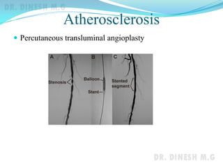 Atherosclerosis
 Percutaneous transluminal angioplasty
 