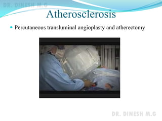 Atherosclerosis
 Percutaneous transluminal angioplasty and atherectomy
 