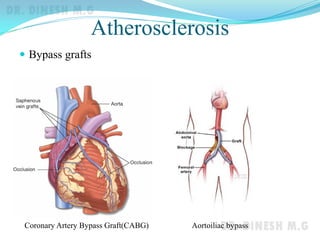 Atherosclerosis
 Bypass grafts
Coronary Artery Bypass Graft(CABG) Aortoiliac bypass
 