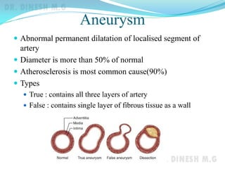 Aneurysm
 Abnormal permanent dilatation of localised segment of
artery
 Diameter is more than 50% of normal
 Atherosclerosis is most common cause(90%)
 Types
 True : contains all three layers of artery
 False : contains single layer of fibrous tissue as a wall
 