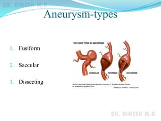 Aneurysm-types
1. Fusiform
2. Saccular
3. Dissecting
 