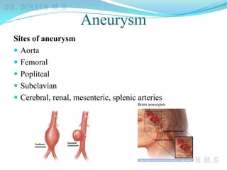 Aneurysm
Sites of aneurysm
 Aorta
 Femoral
 Popliteal
 Subclavian
 Cerebral, renal, mesenteric, splenic arteries
 