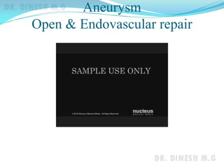 Aneurysm
Open & Endovascular repair
 