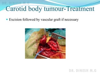Carotid body tumour-Treatment
 Excision followed by vascular graft if necessary
 