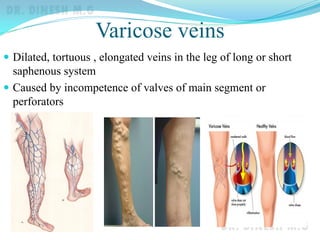 Varicose veins
 Dilated, tortuous , elongated veins in the leg of long or short
saphenous system
 Caused by incompetence of valves of main segment or
perforators
 