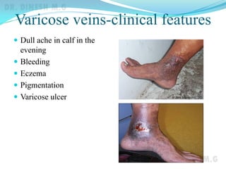 Varicose veins-clinical features
 Dull ache in calf in the
evening
 Bleeding
 Eczema
 Pigmentation
 Varicose ulcer
 