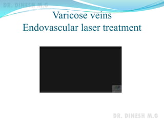 Varicose veins
Endovascular laser treatment
 