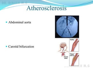 Atherosclerosis
 Abdominal aorta
 Carotid bifurcation
 