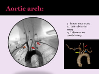 High Riding Innomate Artery radiology Arterial and venous supply of brain neuroimaging part 1 | PPTX