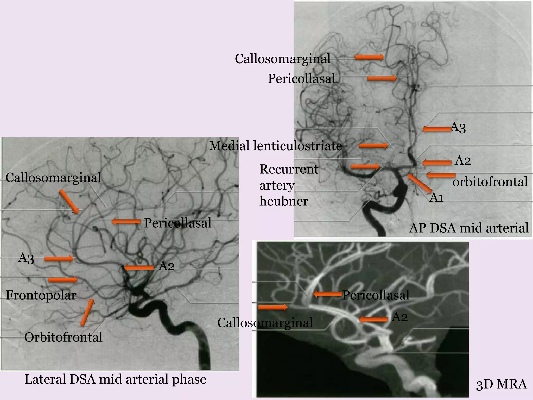 Lateral DSA mid arterial phase
A1
A2
A3
orbitofrontal
Callosomarginal
Pericollasal
Medial lenticulostriate
Recurrent
artery
heubner
Pericollasal
A2
Orbitofrontal
Frontopolar
A3
Callosomarginal
AP DSA mid arterial
3D MRA
A2
Pericollasal
Callosomarginal
 
