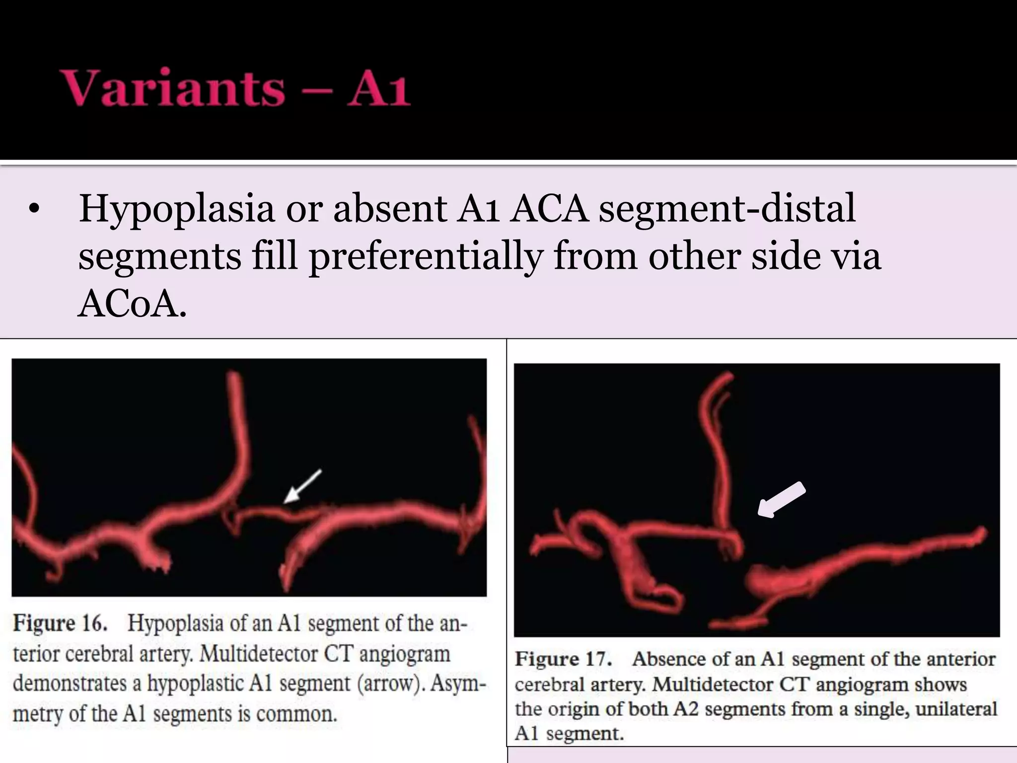 • Hypoplasia or absent A1 ACA segment-distal
segments fill preferentially from other side via
ACoA.
 