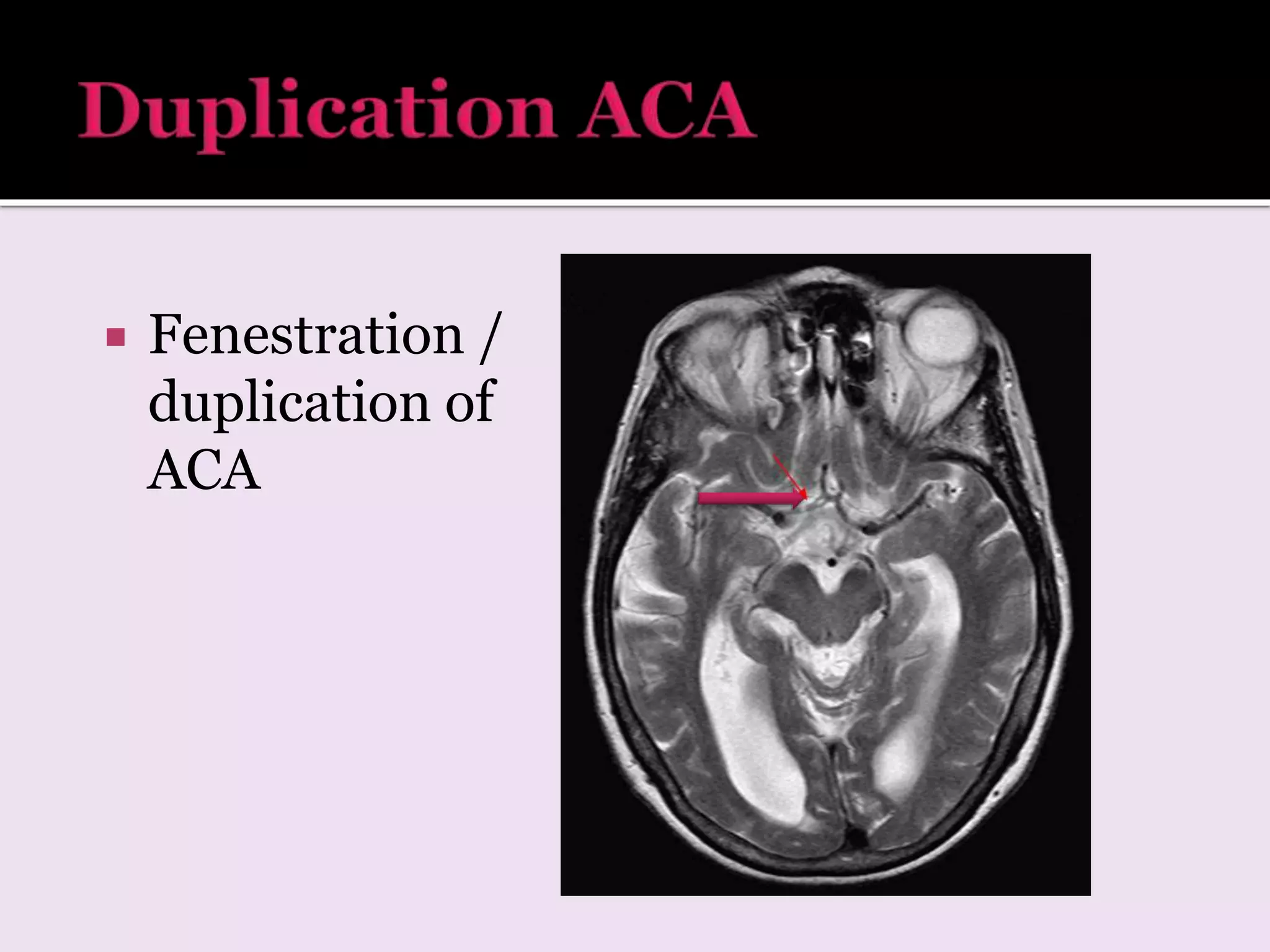  Fenestration /
duplication of
ACA
 