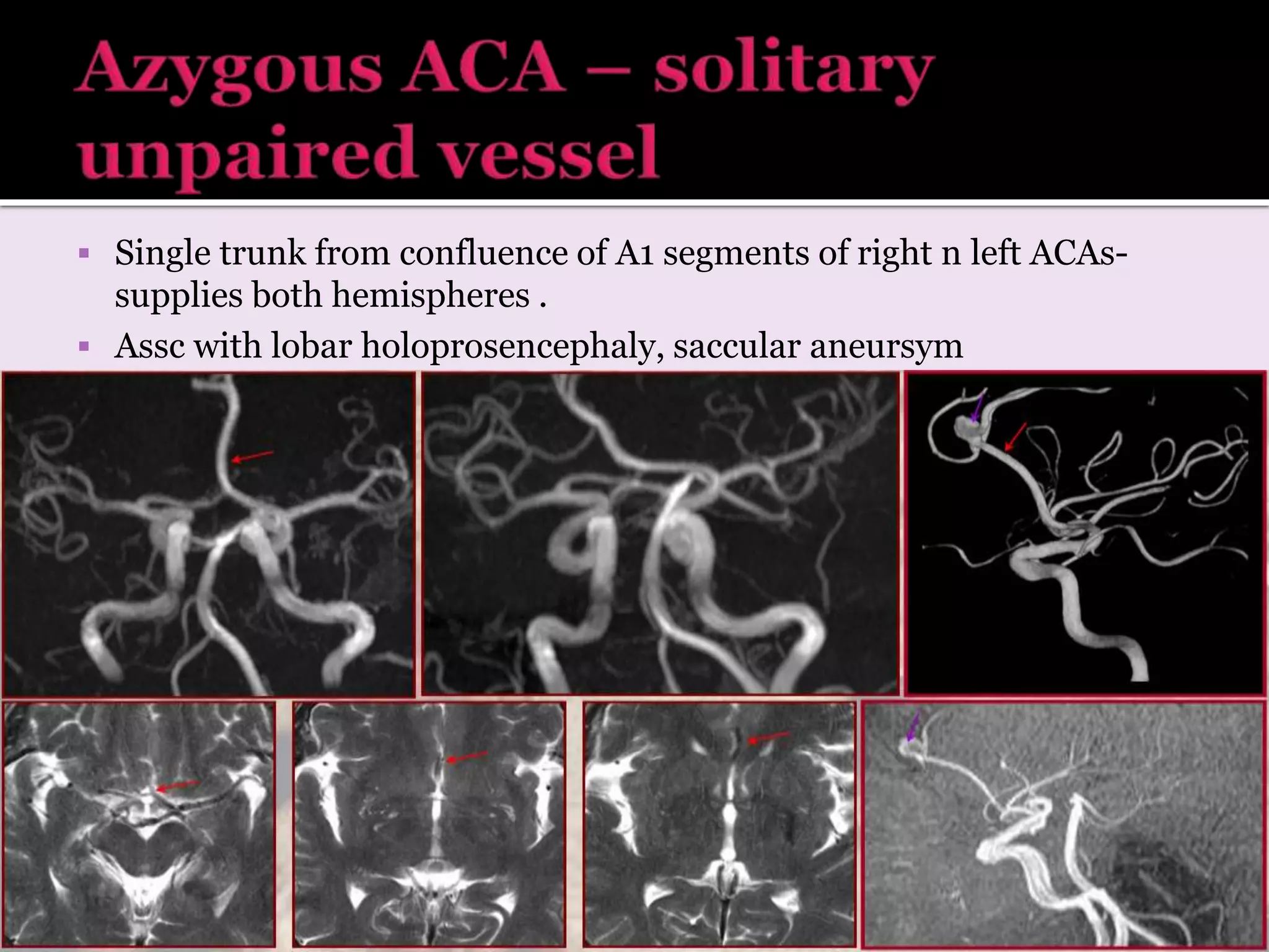  Single trunk from confluence of A1 segments of right n left ACAs-
supplies both hemispheres .
 Assc with lobar holoprosencephaly, saccular aneursym
 