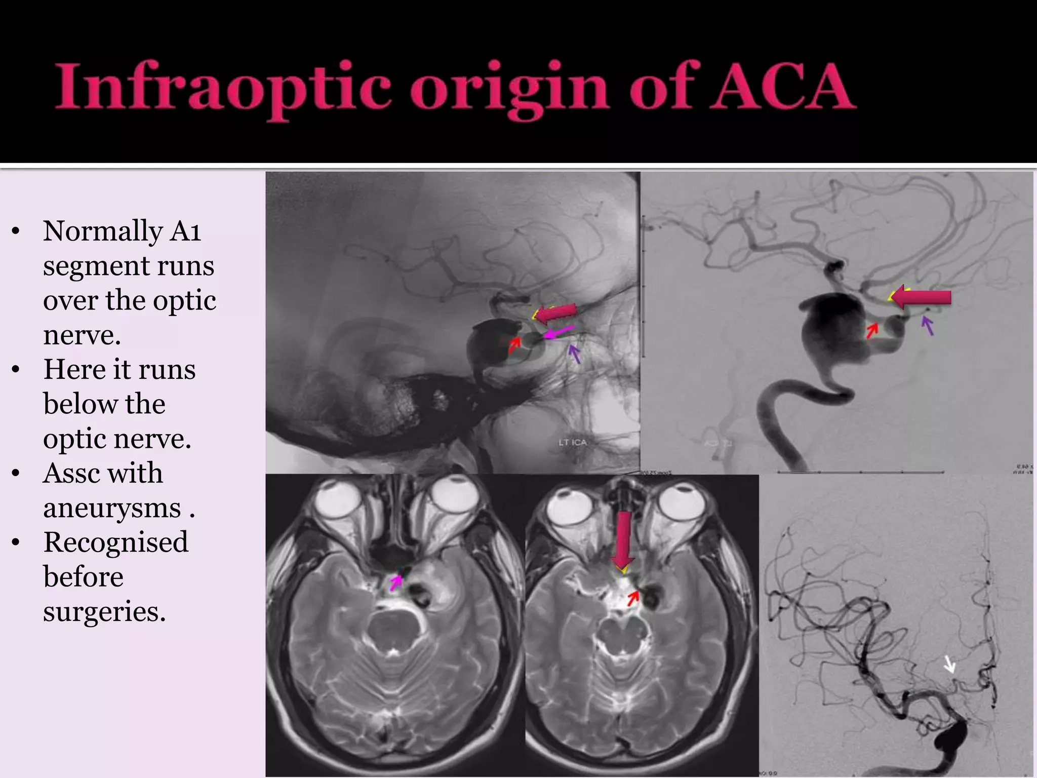 • Normally A1
segment runs
over the optic
nerve.
• Here it runs
below the
optic nerve.
• Assc with
aneurysms .
• Recognised
before
surgeries.
 