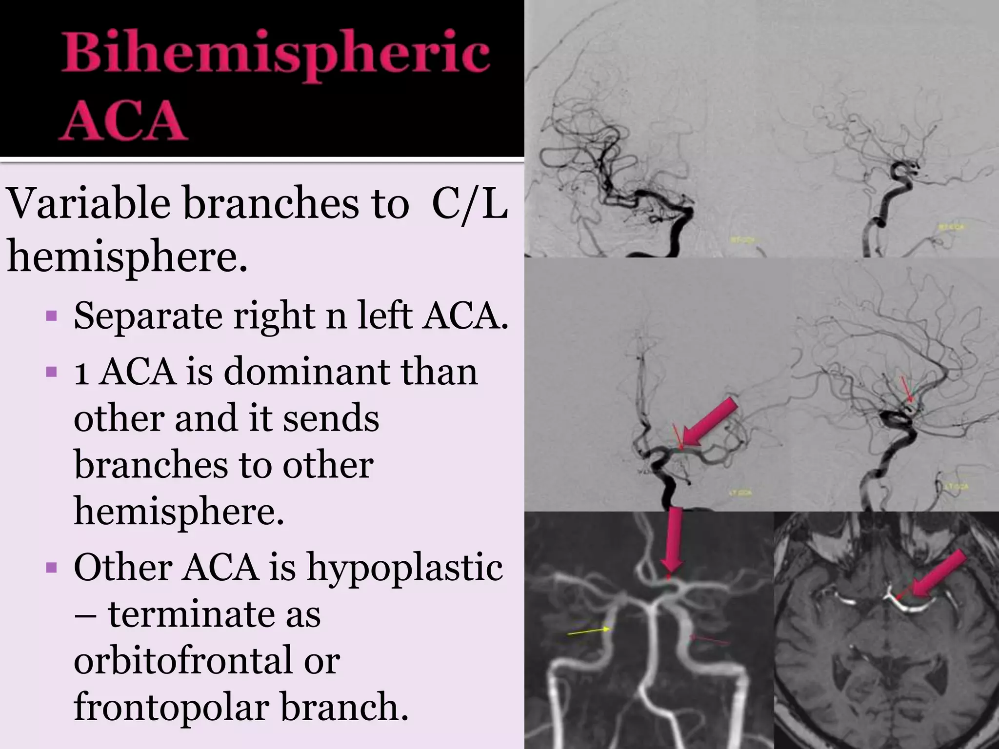 Variable branches to C/L
hemisphere.
 Separate right n left ACA.
 1 ACA is dominant than
other and it sends
branches to other
hemisphere.
 Other ACA is hypoplastic
– terminate as
orbitofrontal or
frontopolar branch.
 