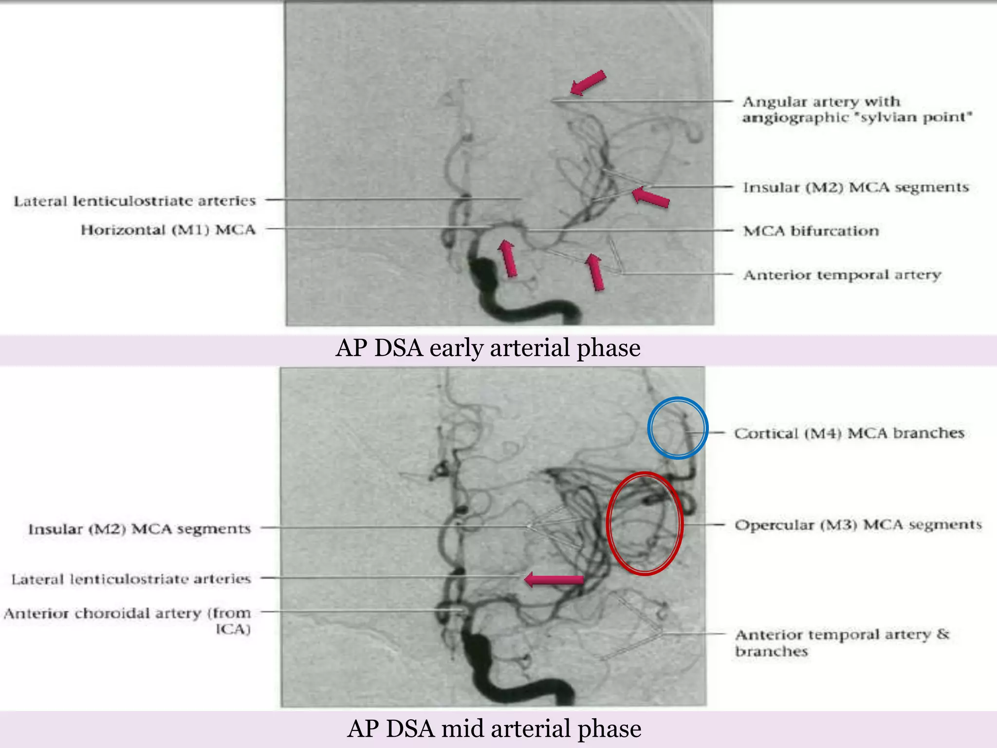 AP DSA mid arterial phase
AP DSA early arterial phase
 