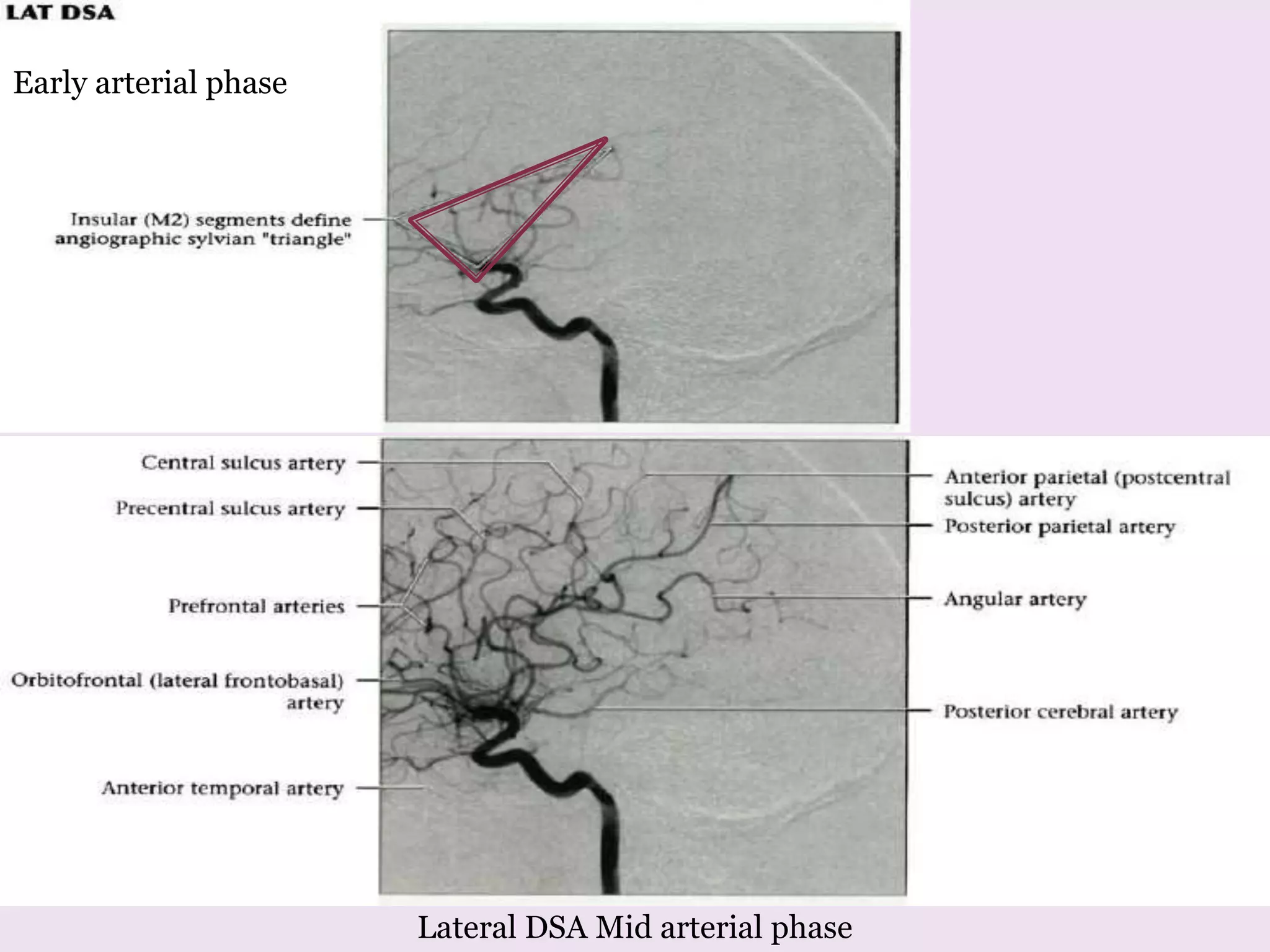 Early arterial phase
Lateral DSA Mid arterial phase
 